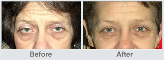 Eyelid and/or Eyebrow Lift Portsmouth