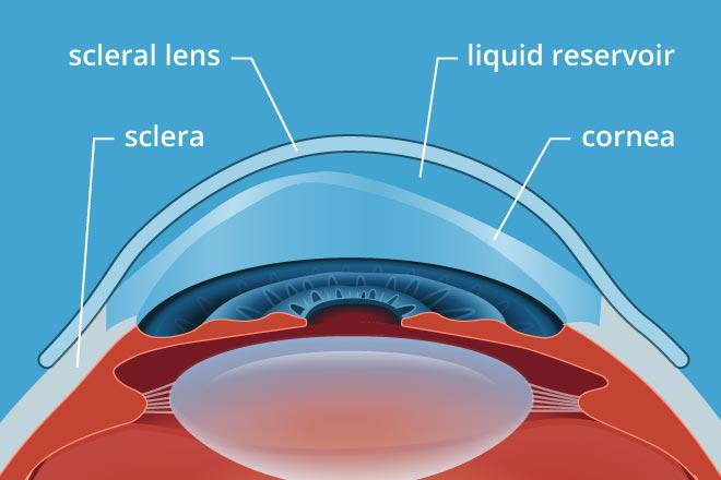 Chart Showing a Scleral Lenses