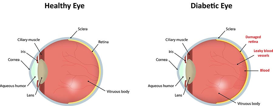 Chart Illustrating a Healthy Eye Compared to One Experiencing Diabetic Retinopathy