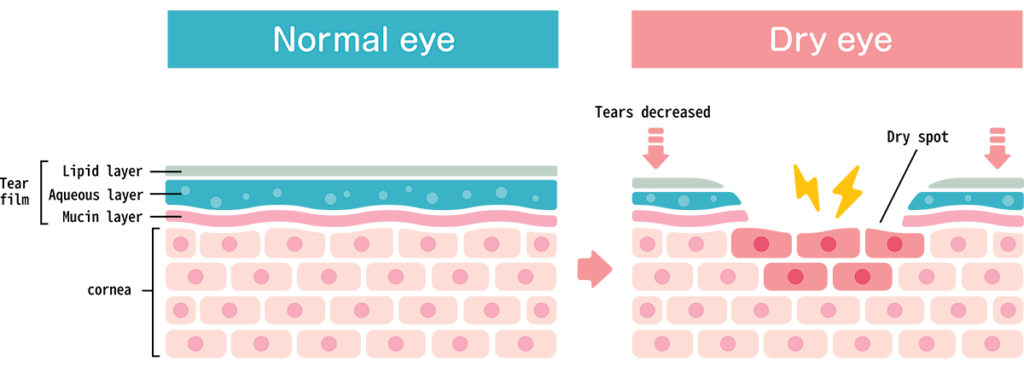 Chart Illustrating a Normal Eye Compared to One Experiencing Dry Eye