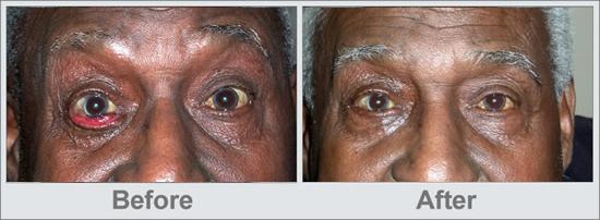 Ectropion Before and After