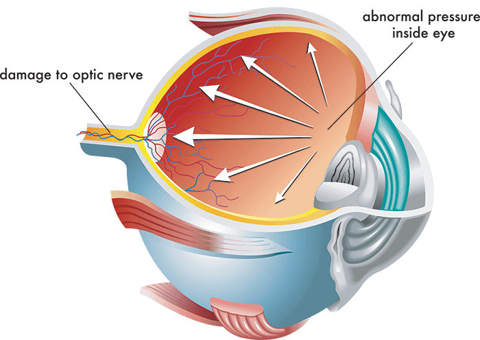 Chart Illustrating How Glaucoma Affects the Eye