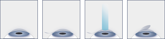 Illustration Showing the LASIK Process