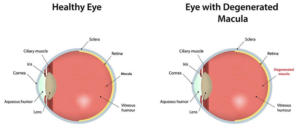 Chart Illustrating a Healthy Eye Compared to an Eye With a Degenerated Macula