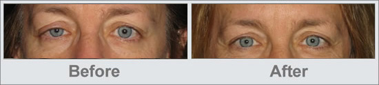 Ptosis Treatment Before and After