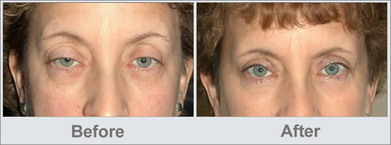 Ptosis Treatment Before and After