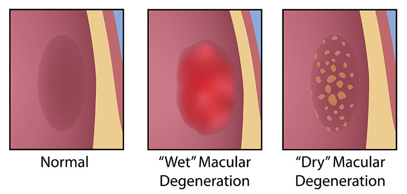 Chart Illustrating a Normal Eye, Eye Experiencing Wet Macular Degeneration and an Eye Experiencing Dry Macular Degeneration